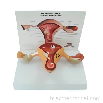 Patoloji ile uterus modeli